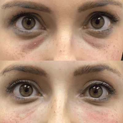 A before and after photo of a person with under-eye dark circles and puffiness, and then with a smooth, radiant complexion after PRP treatment